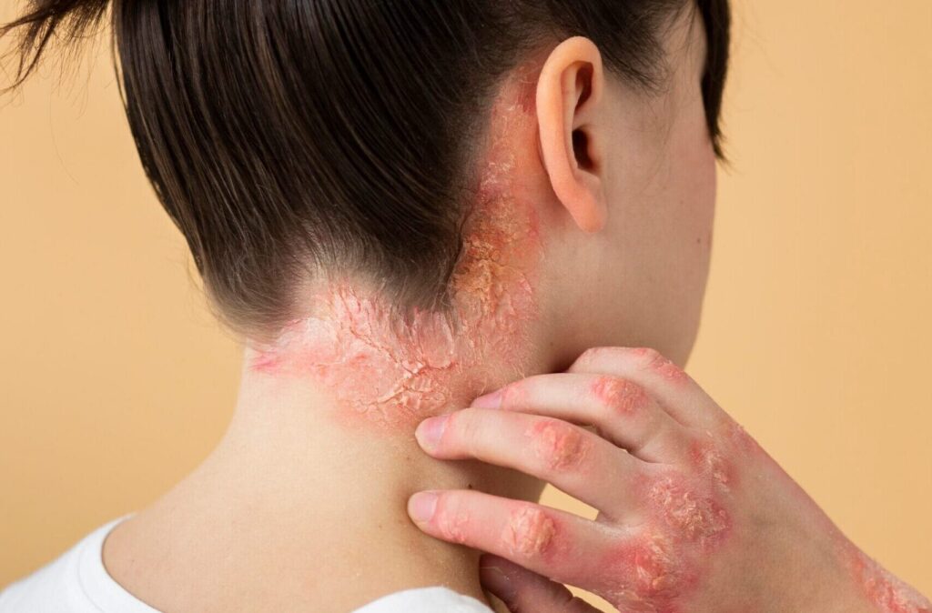 Lupus Psoriasis Probleme lösen
